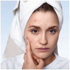 acne-pimples