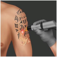 tattoo-removal