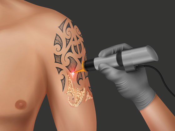 tattoo_removal